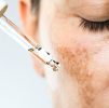 Facial Treatments : Hyperpigmentation