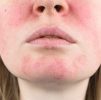 Facial Treatments : Rosacea