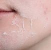 Facial Treatments : Skin Peel