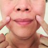 Face Conturing / Dermal Filler Treatments : Marionette Lines 