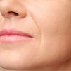 Face Conturing / Dermal Filler Treatments : Nasolabial Folds 