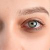 Platelet Rich Plasma (PRP) : Under Eye Dark Circles