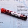 Blood Testing : Anaemia Profile