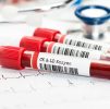 Blood Testing : Andropause Profile