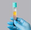 PRP Facial - Natural Skin Rejuvenation