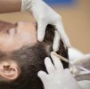 PRP Hair Loss Therapy
