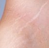 PRP Treatment for Stretch Marks
