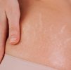 Platelet Rich Plasma (PRP) : PRP (Platelet-rich Plasma) stretch marks
