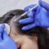 PRP Hair Restoration & Hair Recovery Program - Your journey to thicker, healthier hair
