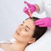Platelet Rich Plasma (PRP) : Hair Loss